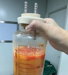 浙江水动力吸脂手术要做多久？